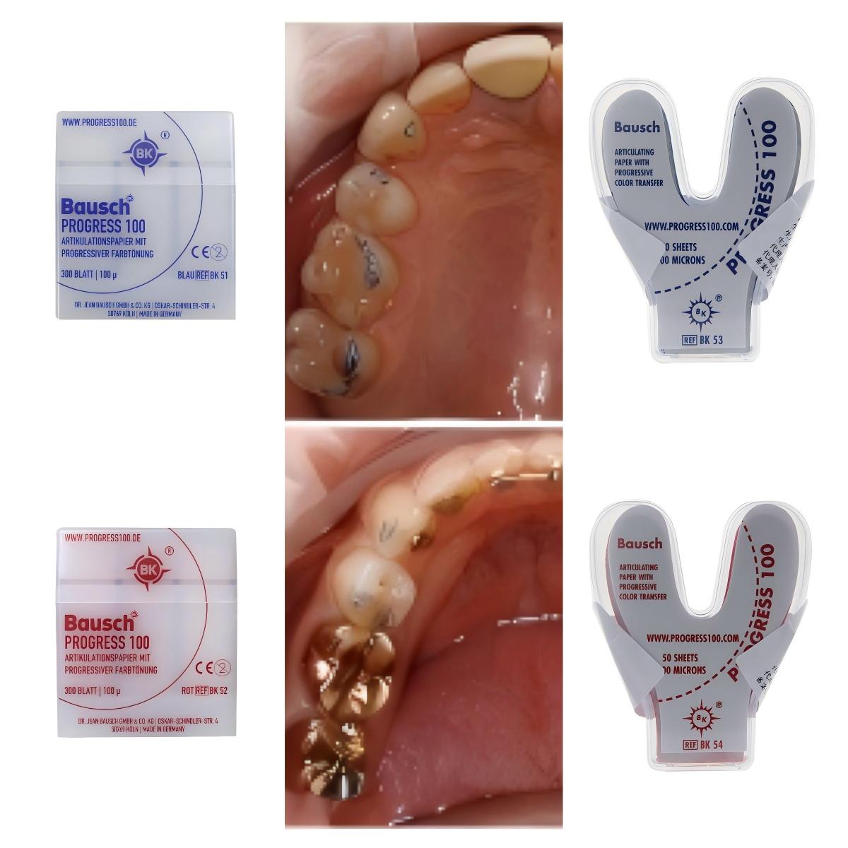 Bausch BK51 BK52 BK53 BK54 Den - مراجعة Bite Indicator وسعره